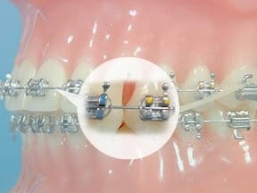 Archwire Johns Creek GA